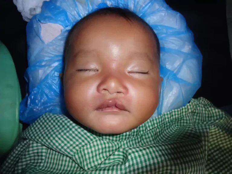 lt. incomplete cleft lip