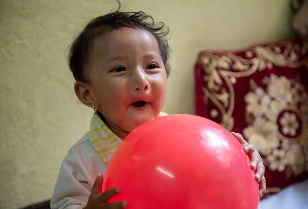 mrighna-with-balloon-after-free-smile-train-cleft-lip-palate-surgery-nepal