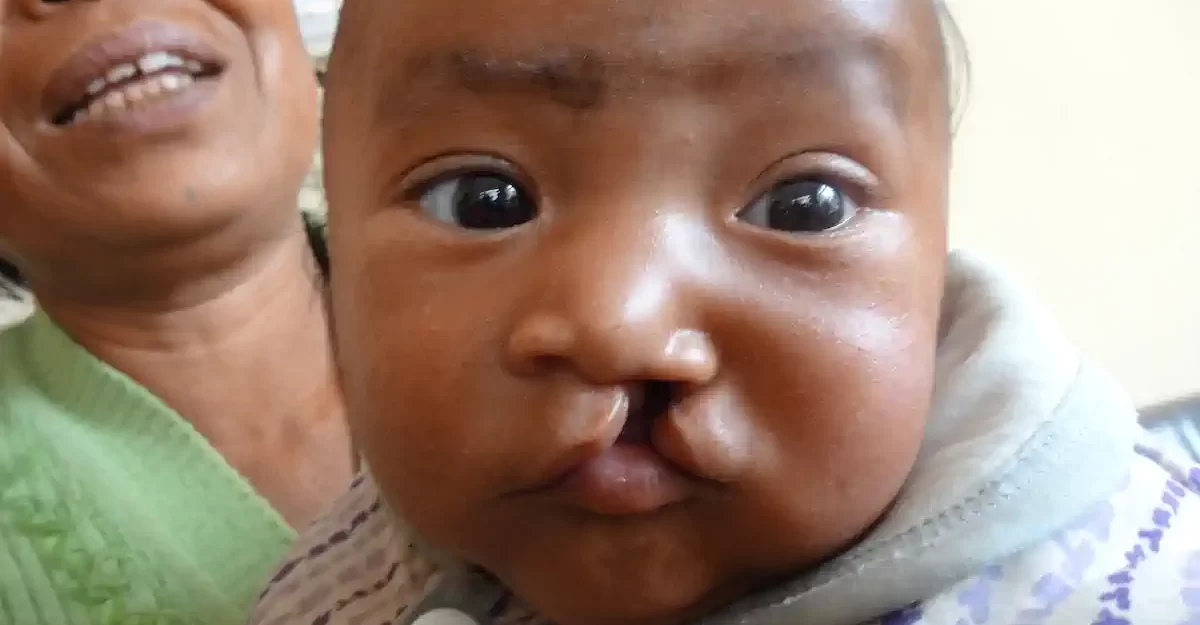 left complete cleft lip